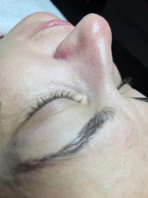 Carboxiterapia After - Salon Exclusive by Adrian Lup | Salon de înfrumusețare Sibiu Carboxiterapia After - Salon Exclusive by Adrian Lup | Salon de înfrumusețare Sibiu